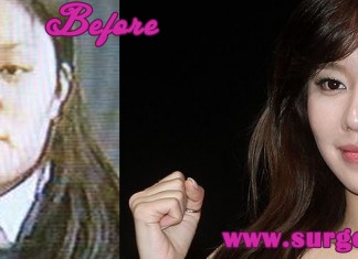 Kim Ah Joong Plastic Surgery