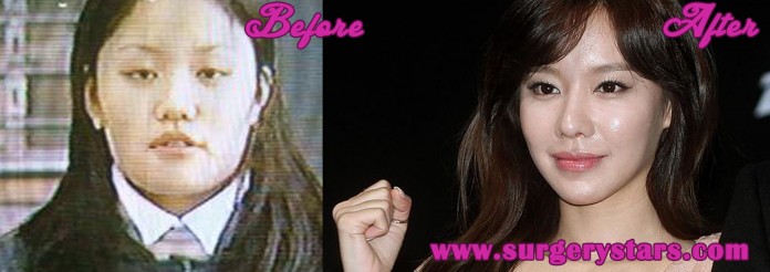 Kim Ah Joong Plastic Surgery