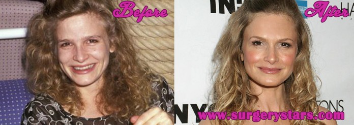 Kyra Sedgwick Plastic Surgery