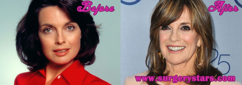 Linda Gray Plastic Surgery