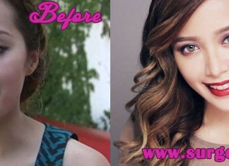 Michelle Phan Plastic Surgery