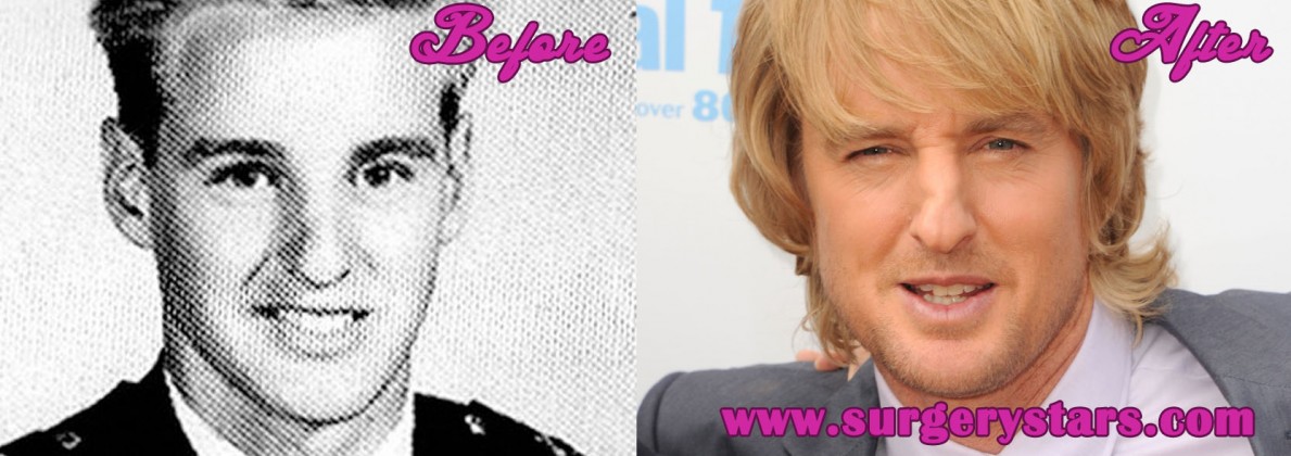 Owen Wilson Plastic Surgery Before And After Nose Job Rumor Pictures Hot Sex Picture 9631