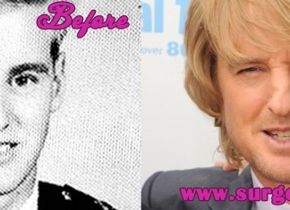 Owen Wilson Nose Job