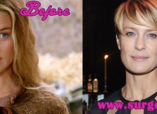 Robin Wright Penn Plastic Surgery