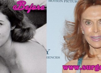 Tina Louise Plastic Surgery