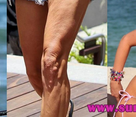 10 Celebrities with Cellulite