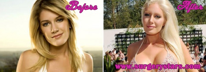 10 celebrities with breast implants