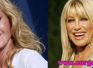 10 celebrities with plastic surgery