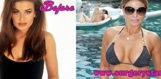 20 Celebrities with Breast Augmentation before and after