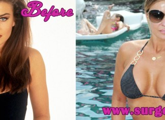 20 Celebrities with Breast Augmentation before and after