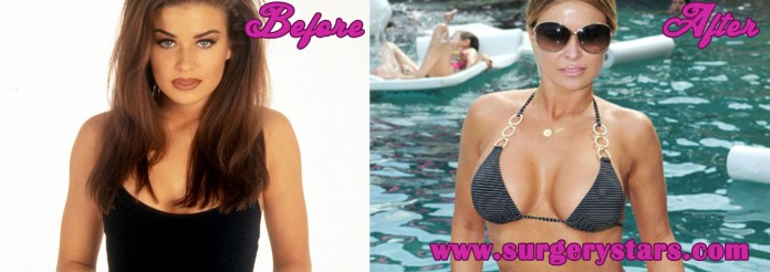 20 Celebrities with Breast Augmentation before and after