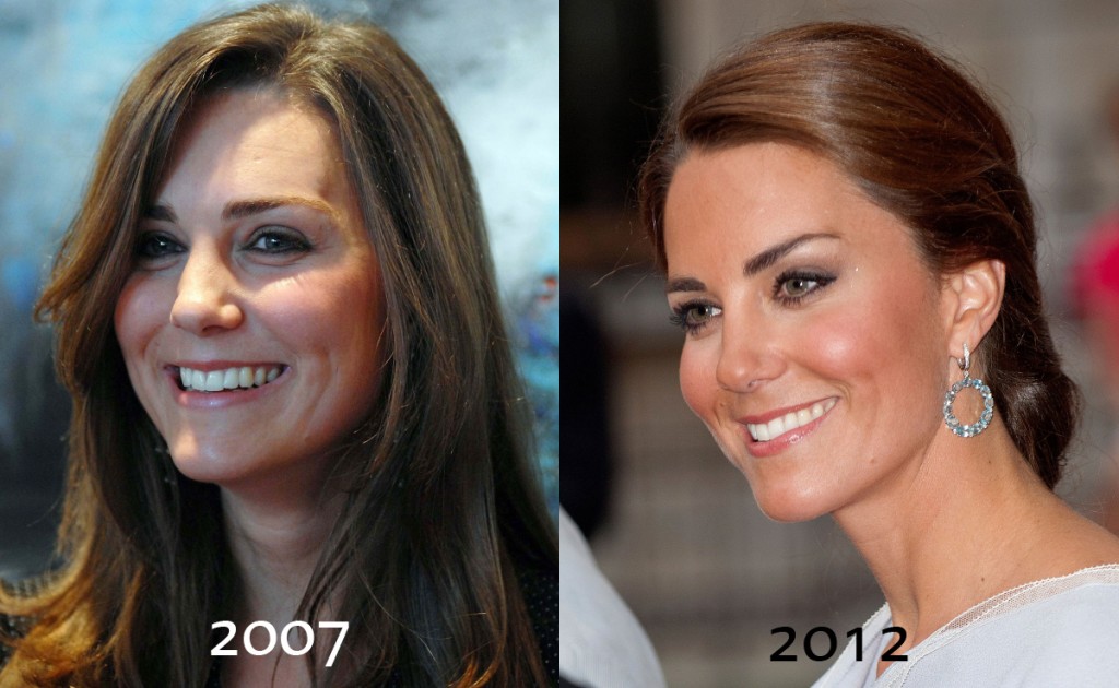 Kate Middleton before and after plastic surgery