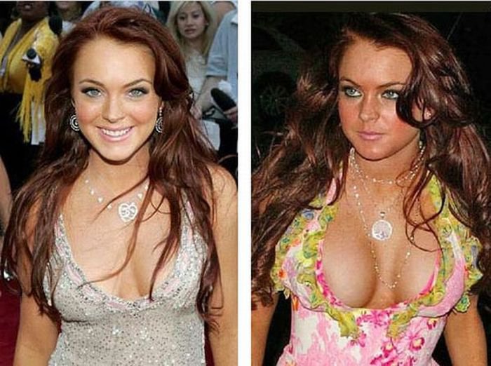 Lindsay Lohan before and after Breast Augmentation