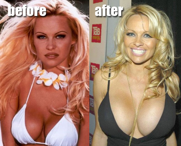 List of 10 Celebrities With Breast Implants