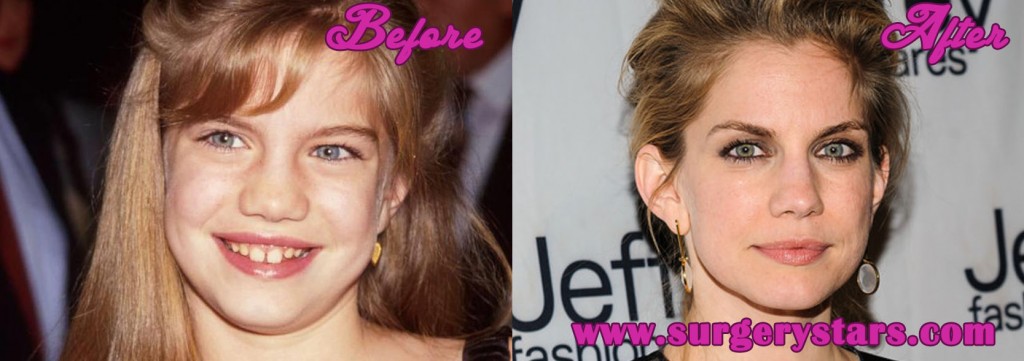 anna chlumsky nose job