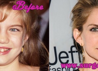 anna chlumsky nose job