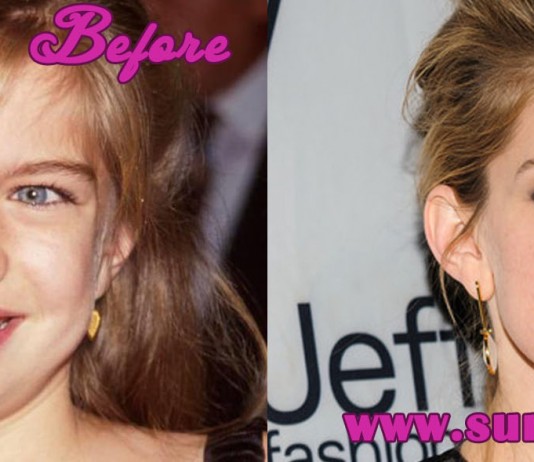 anna chlumsky nose job