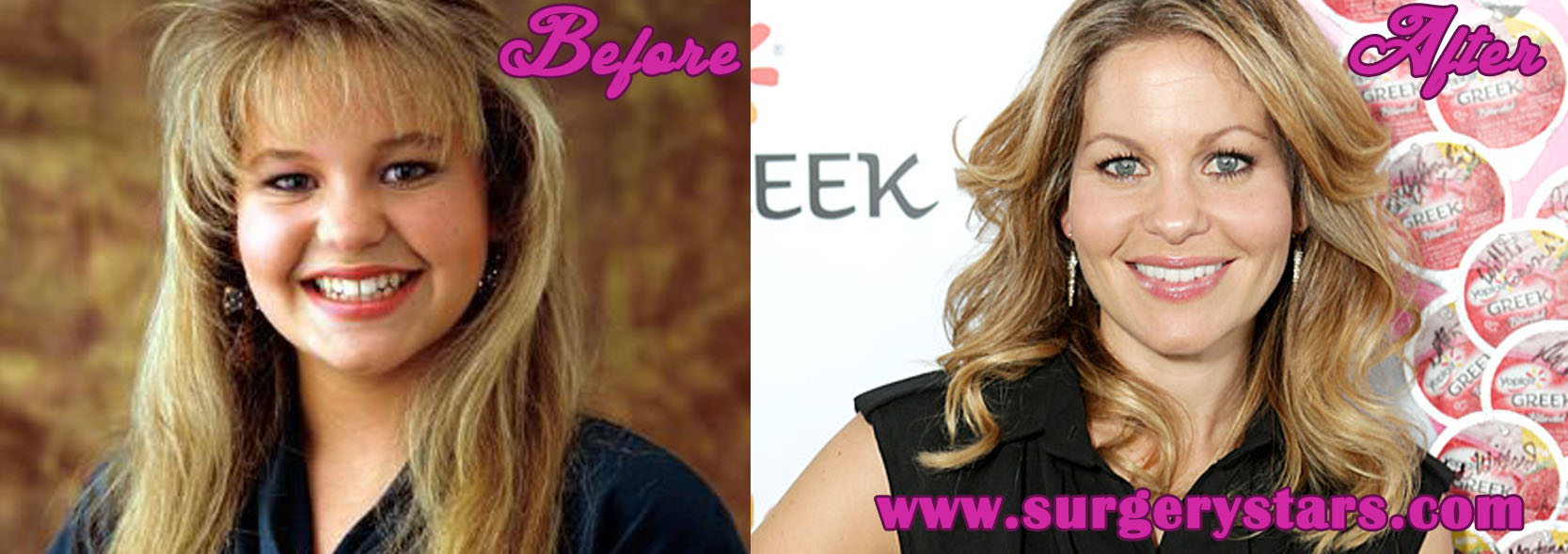 Candace Cameron Plastic Surgery Before and After Pictures