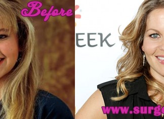 candace cameron plastic surgery