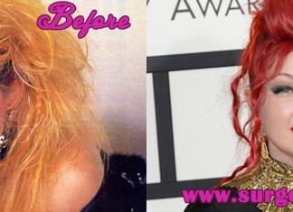 cyndi lauper plastic surgery