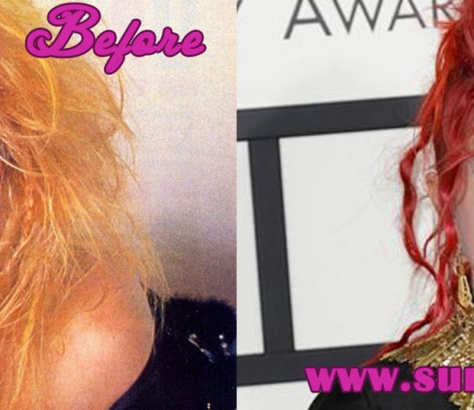 cyndi lauper plastic surgery