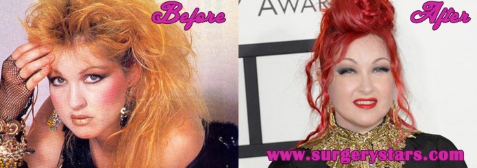 cyndi lauper plastic surgery