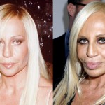 donatella versace before and after plastic surgery