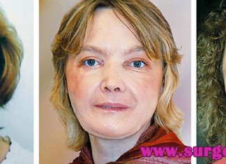 isabelle dinoire plastic surgery