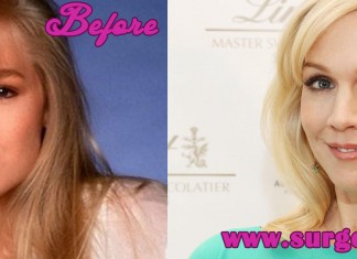 Jennie Garth Plastic Surgery