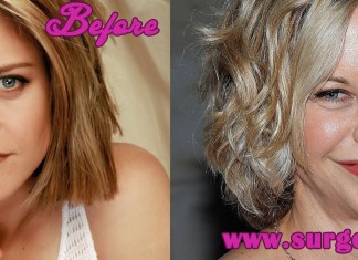 meg ryan plastic surgery disaster