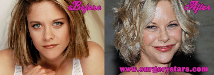 meg ryan plastic surgery disaster