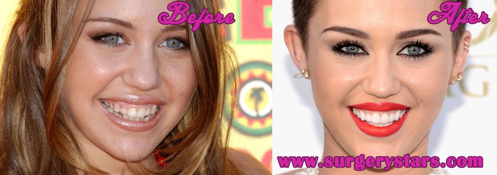 miley cyrus teeth before and after