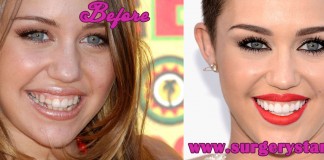 miley cyrus teeth before and after