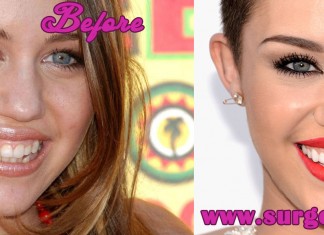 miley cyrus teeth before and after