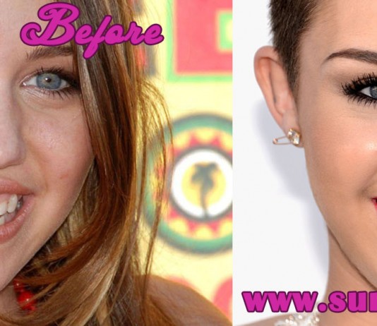 miley cyrus teeth before and after