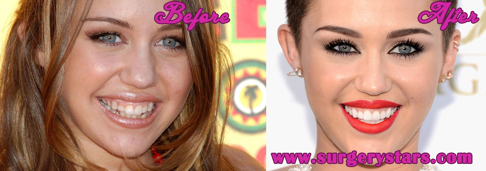 Miley Cyrus Teeth Latest Plastic Surgery Gossip And News | My XXX Hot Girl