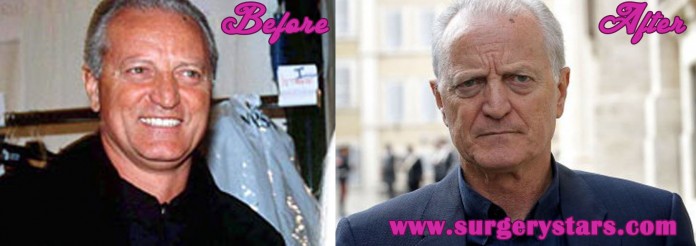 santo versace before and after