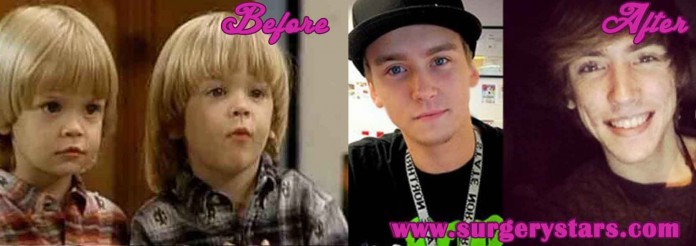 Blake and Dylan Tuomy-wilhoit Before and After Pictures