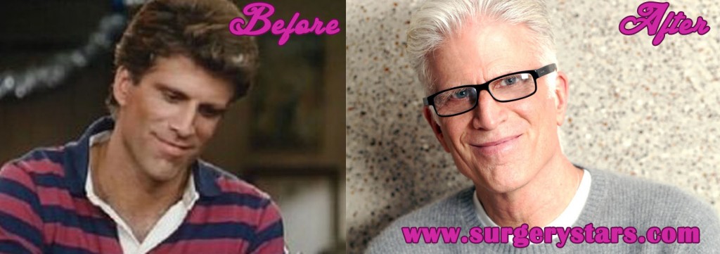 Ted Danson Bald Implants