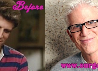 Ted Danson Bald Implants