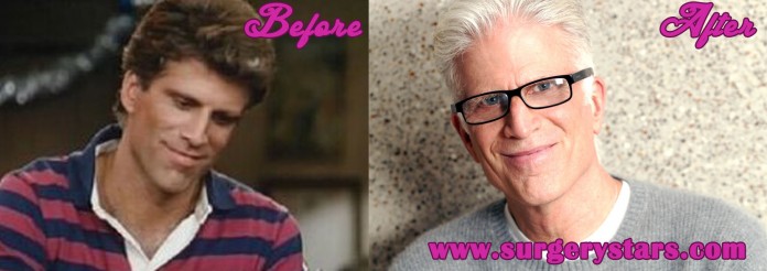 Ted Danson Bald Implants