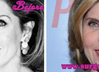 Christine Baranski Plastic Surgery