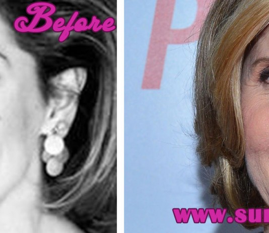 Christine Baranski Plastic Surgery