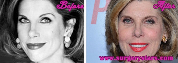 Christine Baranski Plastic Surgery