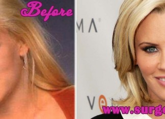 Jenny Mccarthy Plastic Surgery