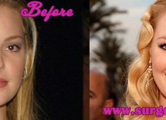 Katherine Heigl Plastic Surgery