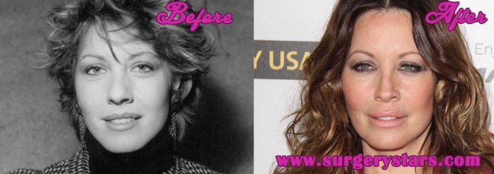 Linda Kozlowski Plastic Surgery