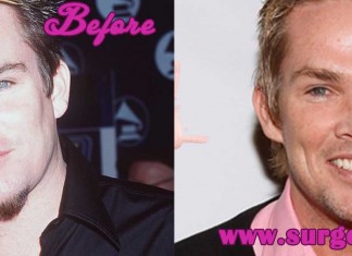 Mark McGrath plastic surgery