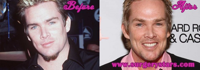 Mark McGrath plastic surgery