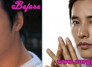 Won Bin Plastic Surgery